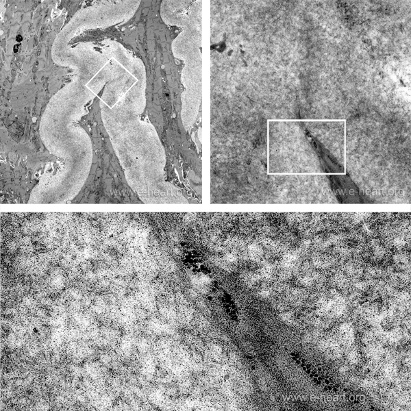 Amyloid TEM
